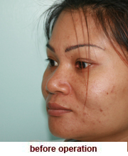 plastic_surgery_augmentation_rhinoplasty